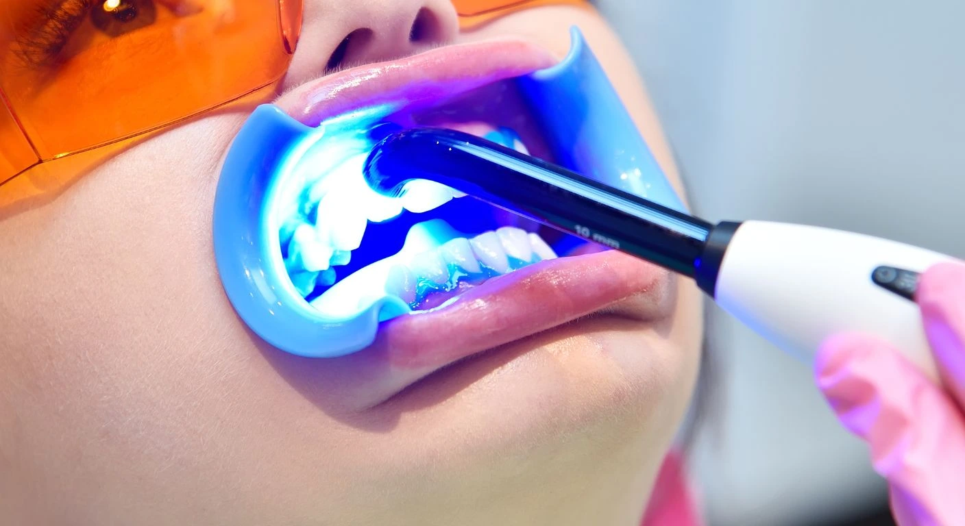 aplicacion-blanqueamiento-dental-profesional