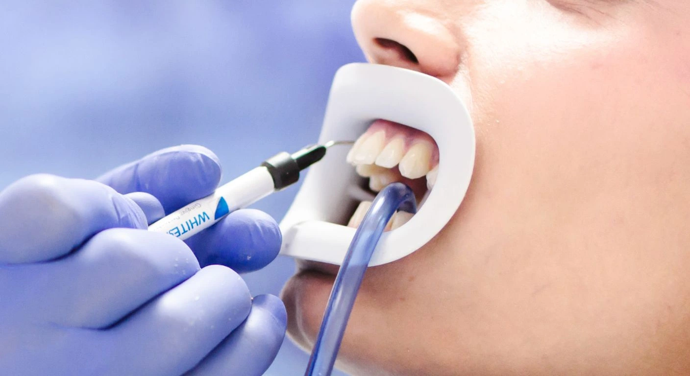 aplicacion-de-blanqueamiento-dental-profesional