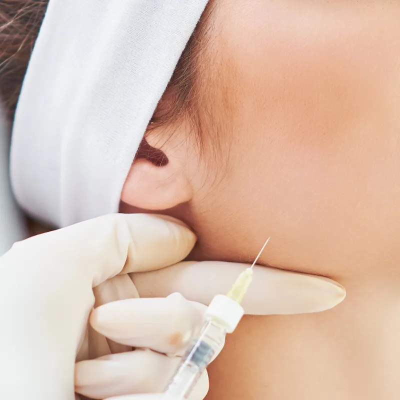 ejemplo colocacion toxina botulinica - Diseño de Sonrisa - Clinica Dental Jardines