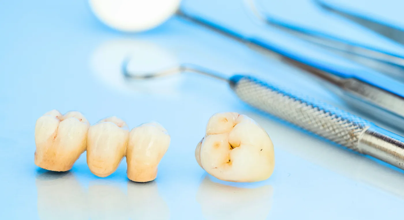 dientes con caries incipientes - Resinas Dentales - Clinica Dental Jardines