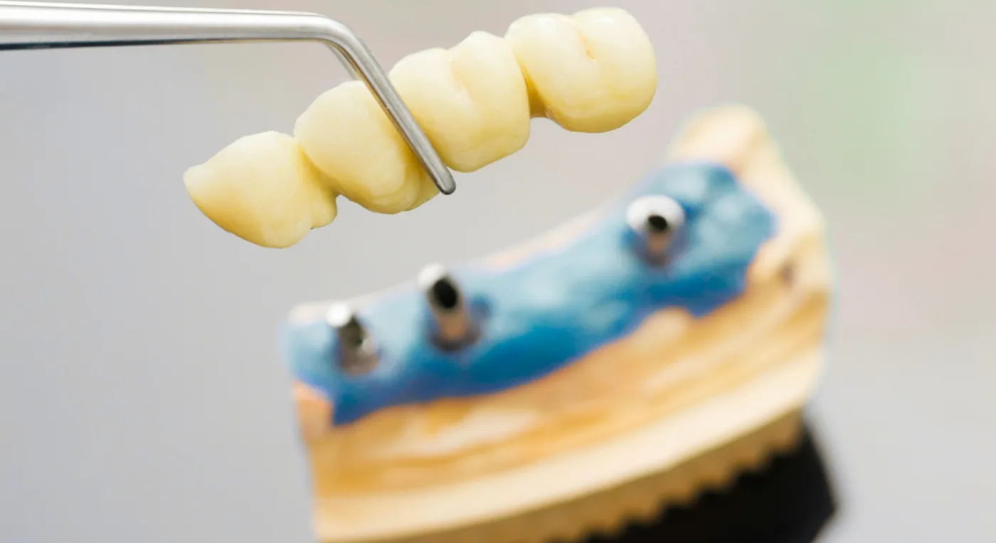 ejemplo-puente-soportado-sobre-implantes-dentales ejemplo puente soportado sobre implantes dentales - Implantes Dentales - Clinica Dental Jardines