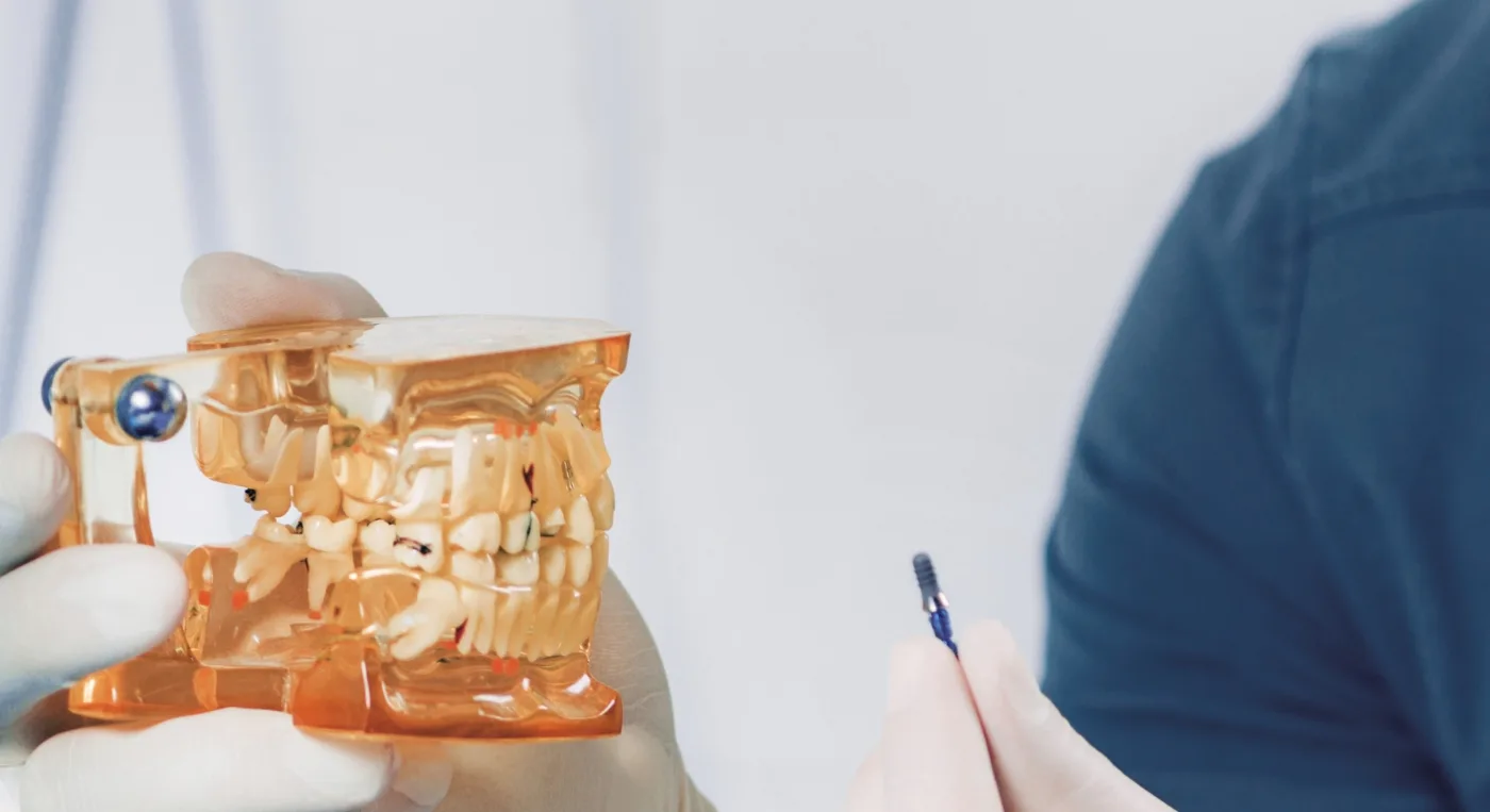 implante-dental-individual implante dental individual - Implantes Dentales - Clinica Dental Jardines