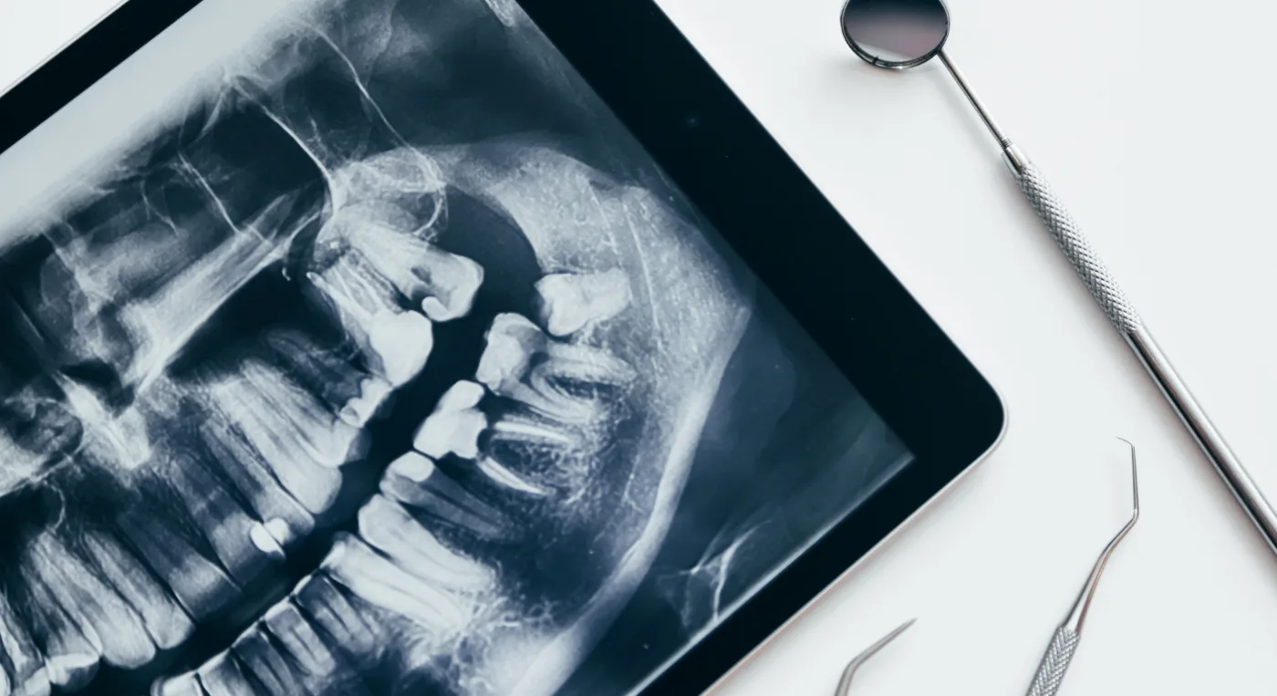 radiografia-dental-cirugia-tercer-molar radiografia dental cirugia tercer molar - Tratamientos Clínicos - Clinica Dental Jardines