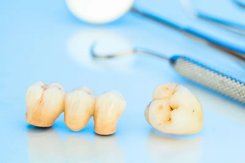 dientes con caries incipientes - Resinas Dentales - Clinica Dental Jardines