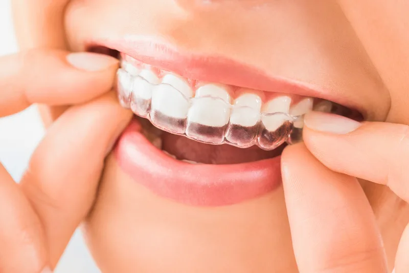 laptop muestra radiografía digital como apoyo para realizar un diagnóstico preciso en la primera visita dental