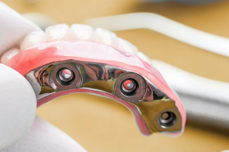 mano de dentista sosteniendo una prótesis dental completa para fijarla sobre implantes dentales