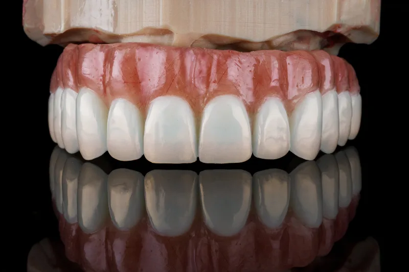 molde de prótesis dental fija sobre implantes dentales