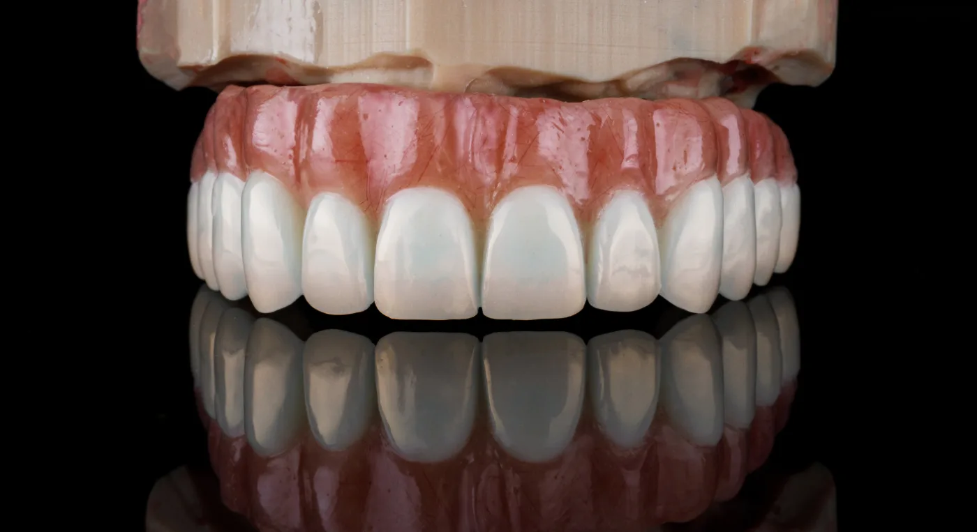 protesis-dental-fija-sobre-sobre-implantes-dentales Muestra de prótesis dental fija completa soportada por implantes dentales