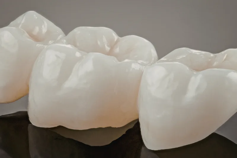 representación de puente dental compuesto de tres coronas dentales como solución del tratamiento de prótesis dental