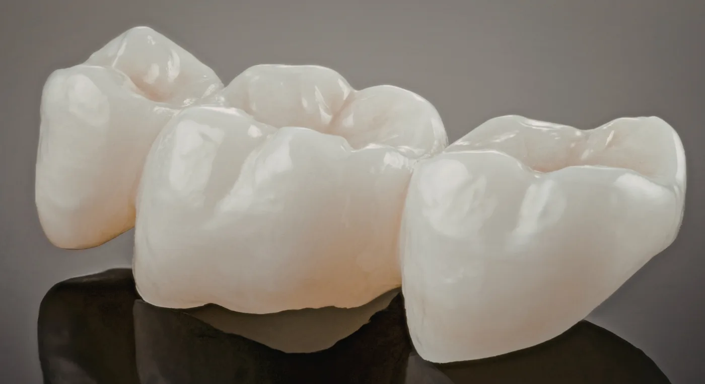 puente-dental-coronas-dentales Representación de puente dental compuesto de tres coronas dentales como solución del tratamiento de prótesis dental