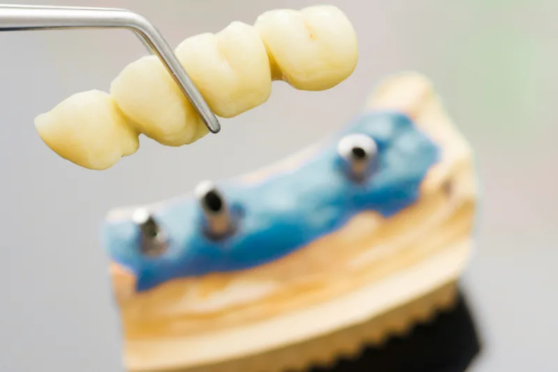 pinzas sosteniendo un puente dental que se fijará sobre tres implantes dentales