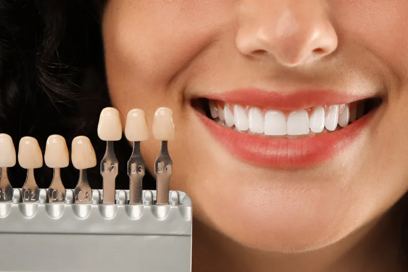 tonos para resinas dentales - Resinas Dentales - Clinica Dental Jardines